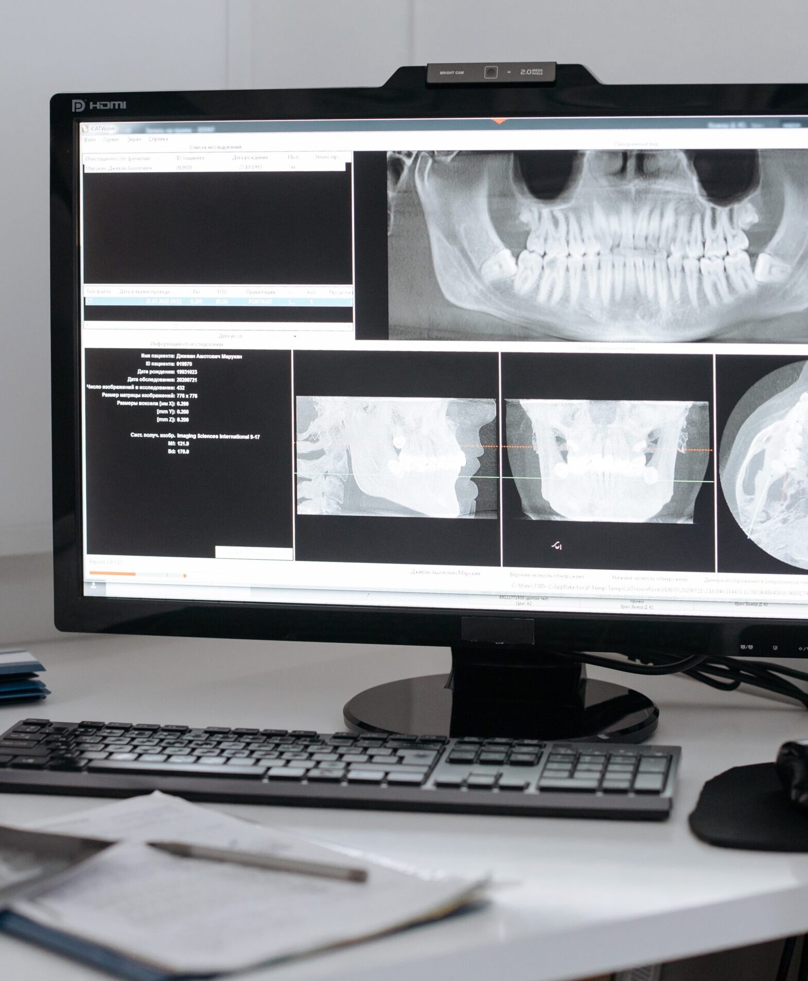 San Diego dentist top implants 1 scaled e1680676800233