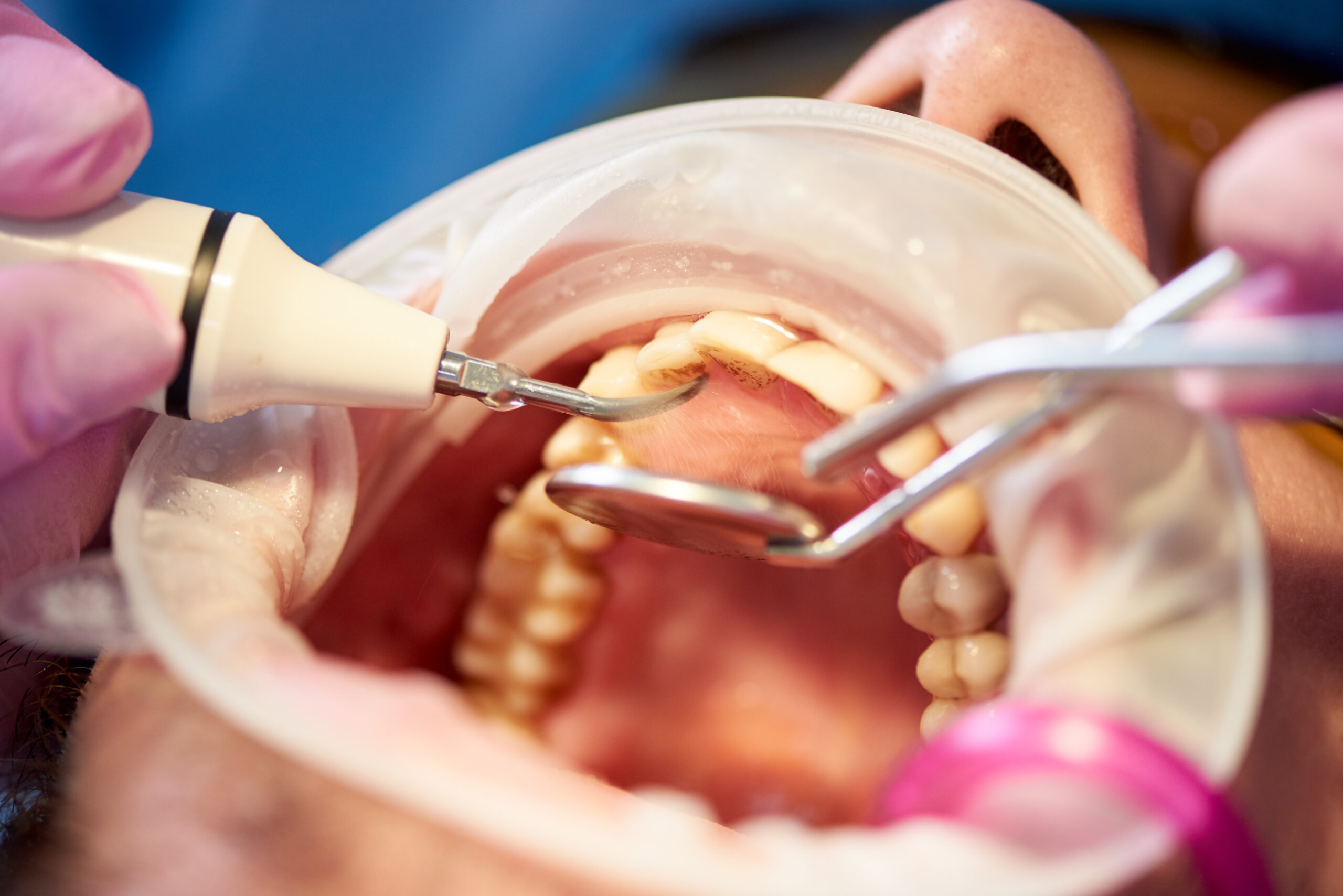 Macro photo of an examination of a patient with tartar in a clinic with innovative technologies.