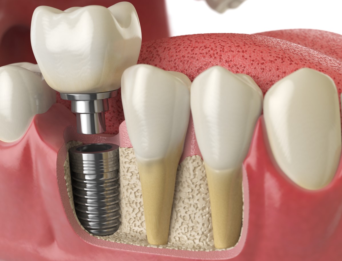 Dental Implant min